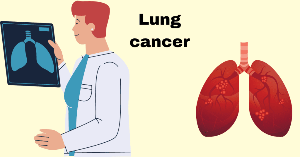Lung cancer
